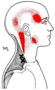 Pic 1- Upper Trapezius Trigger Point Pattern